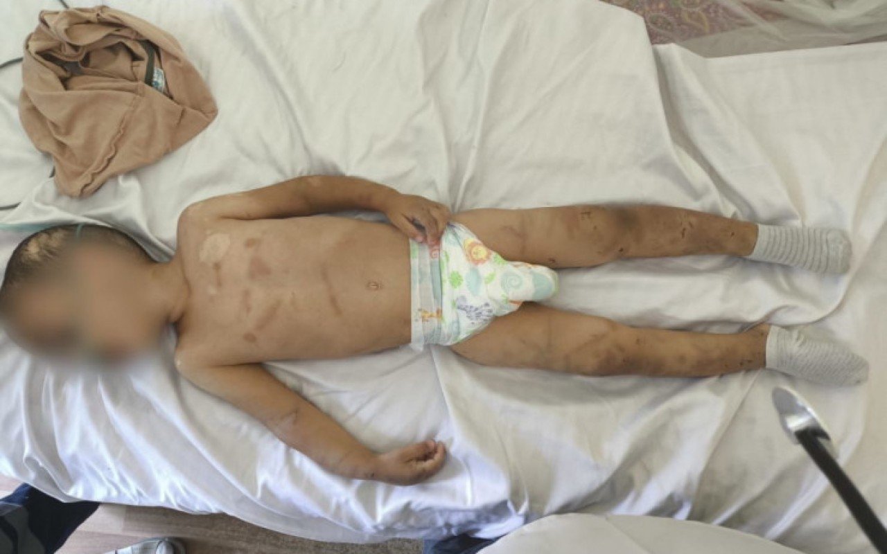 Valideynləri tərəfindən döyülən azyaşlı komadadır